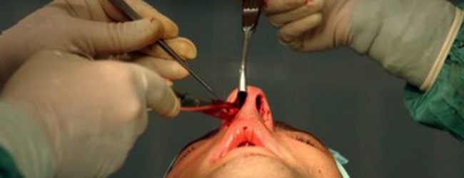 جراحی انحراف بینی : جراحی انحراف بینی چگونه است