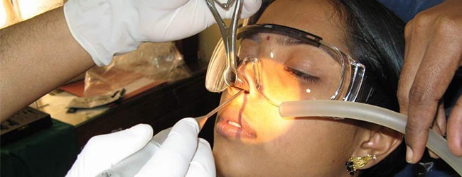 جراحی انحراف بینی : جراحی انحراف بینی با لیزر