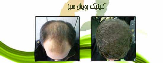 بهترین کلینیک کاشت مو در تهران : کلینیک کاشت مو رویش سبز