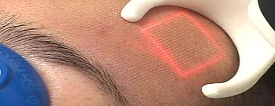دستگاه های جوانسازی پوست : مراقبت‌های قبل و بعد از استفاده از دستگاه جوانسازی پوست لیزر CO2 فرکشنال