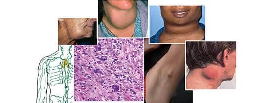 سرطان هوچیکین : علائم و نشانه‌های بیماری لنفوم هوچکینی | بیماری هوچکین
