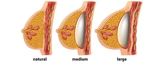 پروتز سینه : محل قرار دادن پروتز داخل سینه