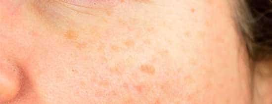 روغن خراطین برای صورت خوبه یا نه؟ |خصوصیات روغن خراطین اصل %D8%B1%D9%88%D8%BA%D9%86 %D8%AE%D8%B1%D8%A7%D8%B7%DB%8C%D9%86 %D8%A8%D8%B1%D8%A7%DB%8C %D9%BE%D9%88%D8%B3%D8%AA 2 روغن خراطین برای صورت خوبه یا نه؟ |خصوصیات روغن خراطین اصل