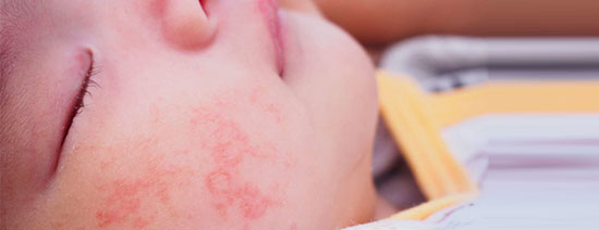 راه‌های مراقبت از پوست حساس کودک